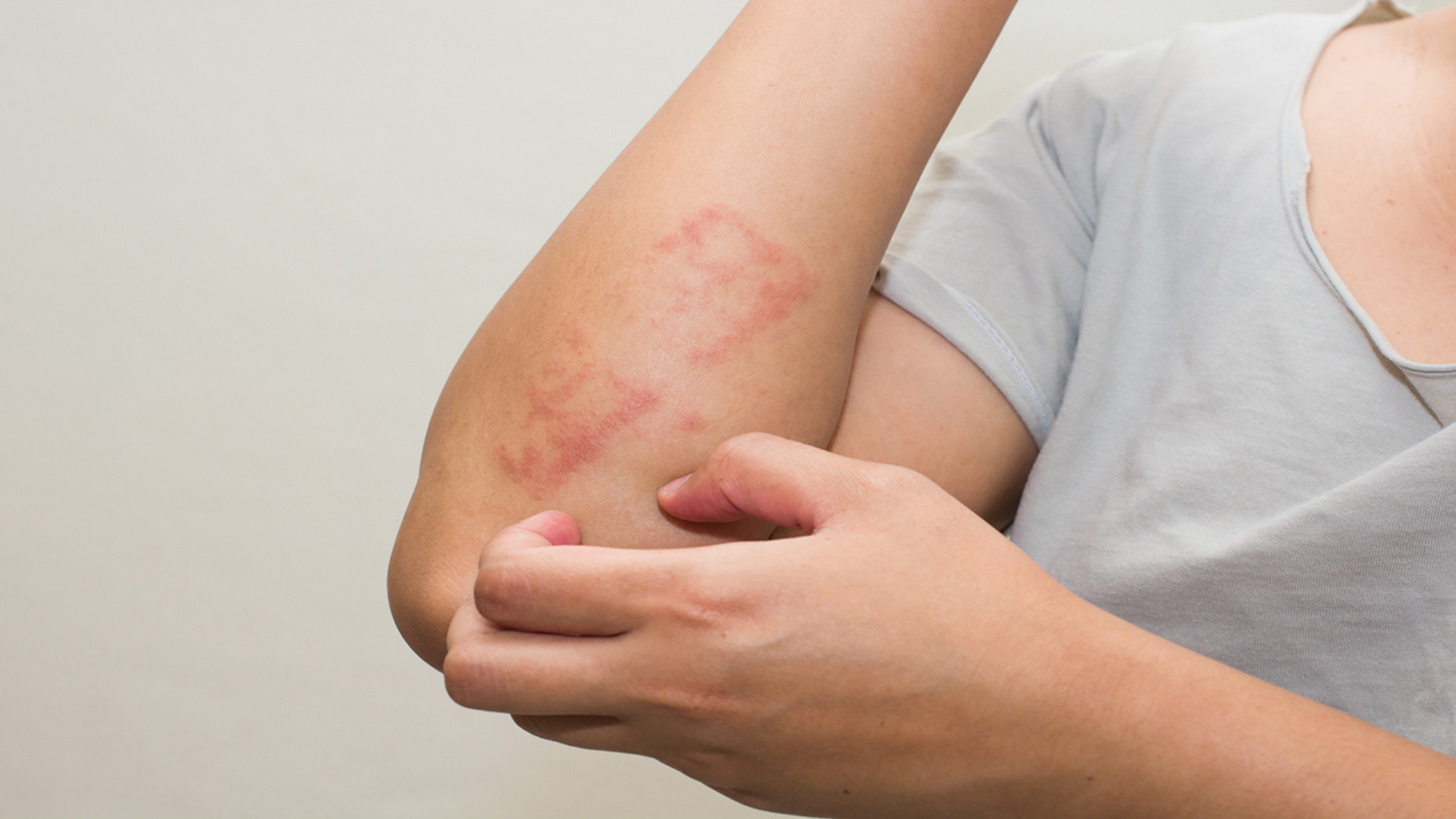 What is psoriasis?